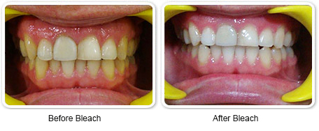 bleaching_before_after